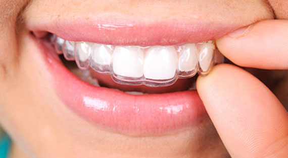 Entenda como funciona o alinhador dental transparente 
