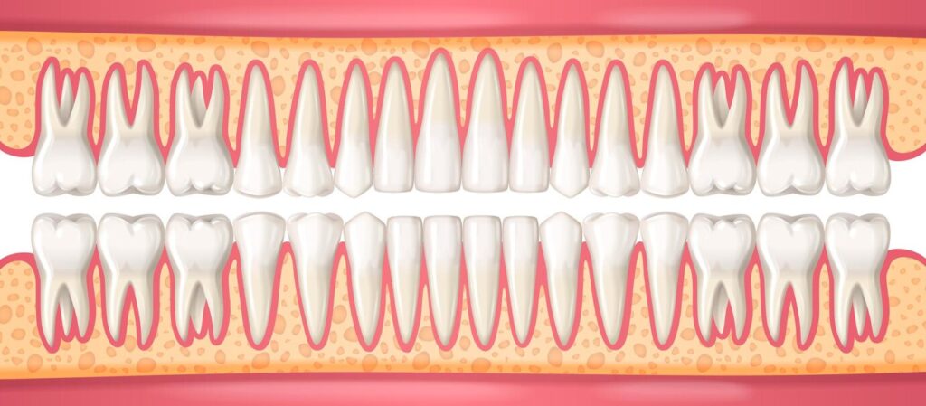 reabsorção da raiz do dente